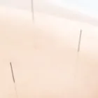 美容鍼